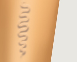 Picior care prezintă vene varicoase