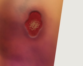 Picior afectat de un ulcer venos deschis