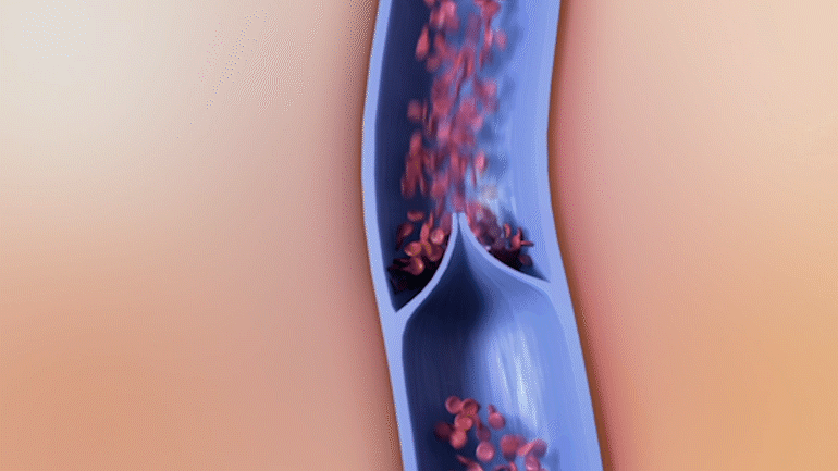 Ilustrație cu vena sănătoasă care arată compresia normală a venei care susține circulația înapoi la inimă