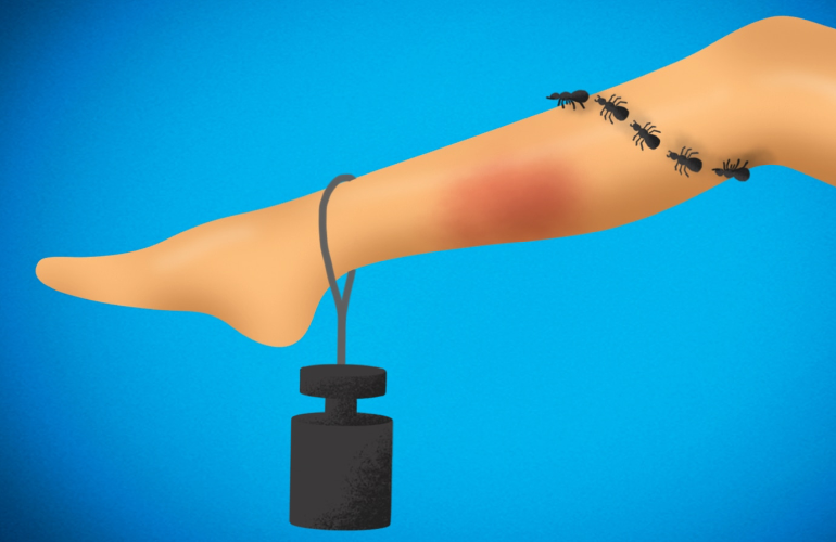 Picior greu cu vene varicoase și înroșire