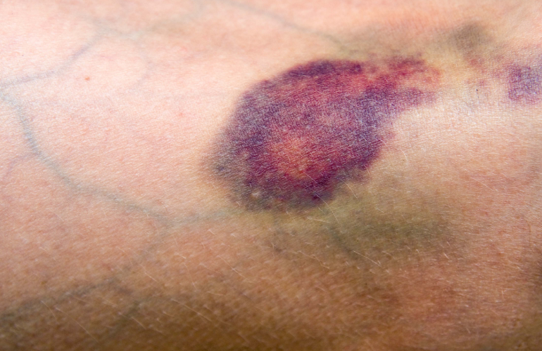 Prim plan al hematomului pe piele cu vânătăi roșii și purpurii.
