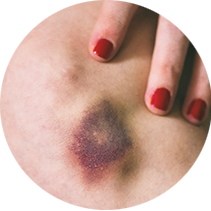 Vânătăi și hematoame