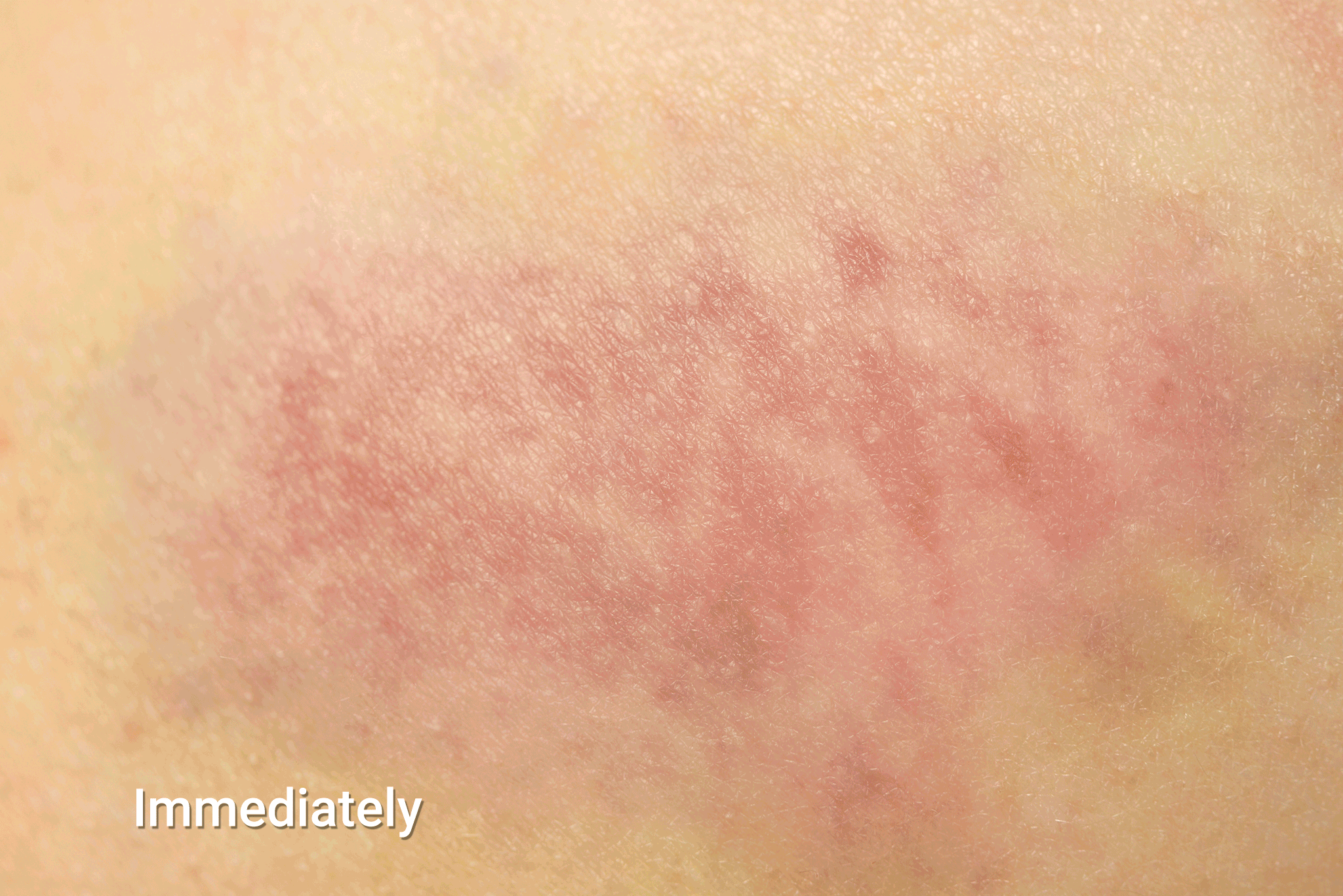 Fotografie de hematom subcutanat hematom subcutanat în timp