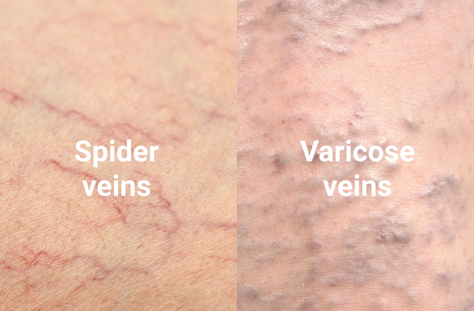 fotografie în care se compară venele păianjenului și venele varicoase