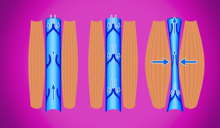 Иллюстрация здоровой вены, показывающая нормальную компрессию вены, которая поддерживает циркуляцию назад к сердцу